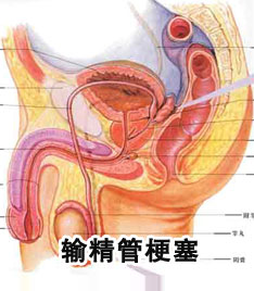 输精管堵塞怎样治疗效果好