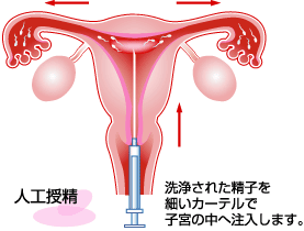 郑州人工授精可以包生男孩吗